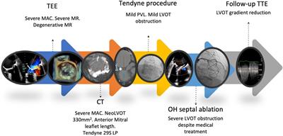 Left ventricular outflow tract obstruction after transcatheter mitral valve replacement: a case report with a multifaceted approach